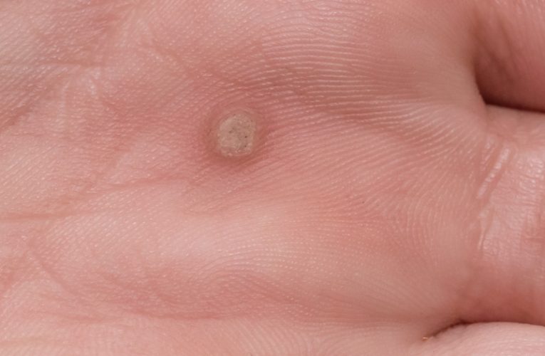 Here’s Why You Have Warts And How To Remove Them